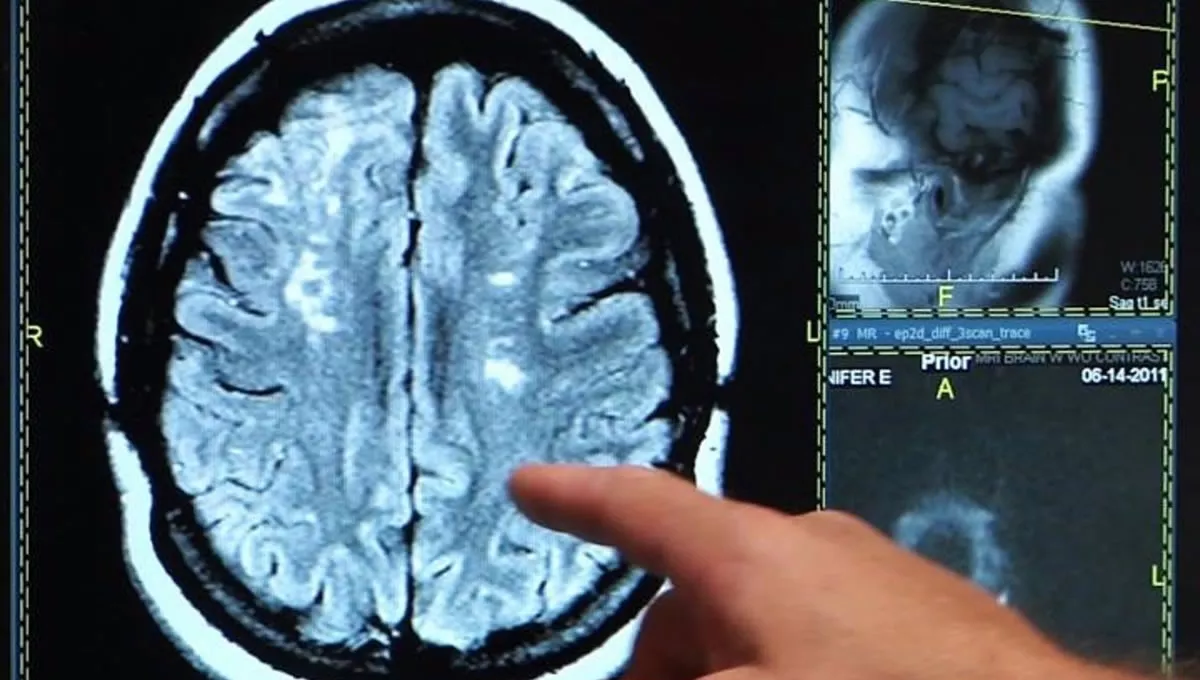 Ictus, derrame cerebral, cerebro (Foto: Onald Reagan UCLA Medical Center/EuropaPress)