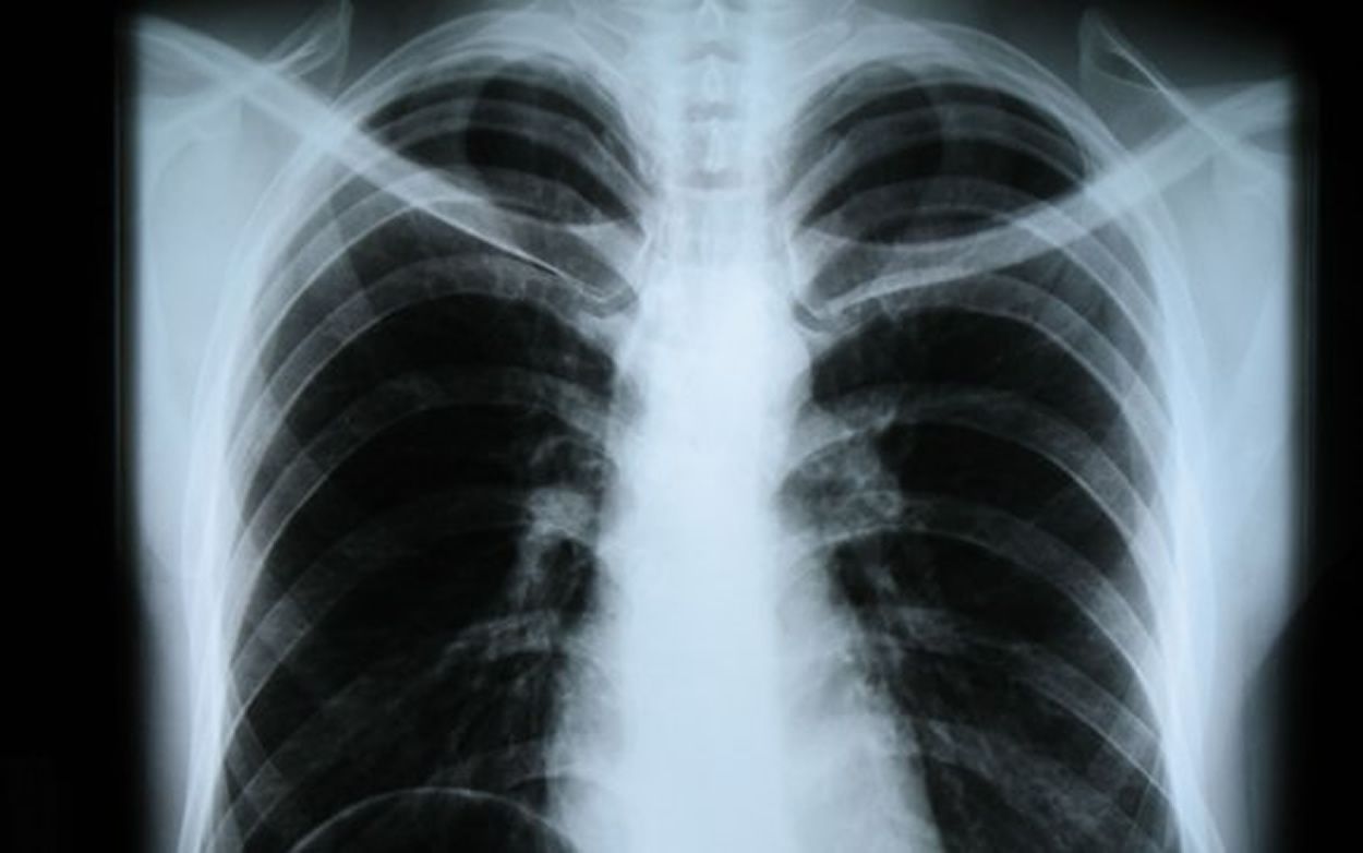 El infradiagnóstico de la bronquiectasias responde a su similitud con otras patologías