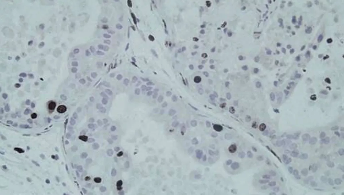 Tumores de próstata de modelos murinos preclínicos en los que se ha eliminado el gen Mettl1.   CIC (CSIC USAL)