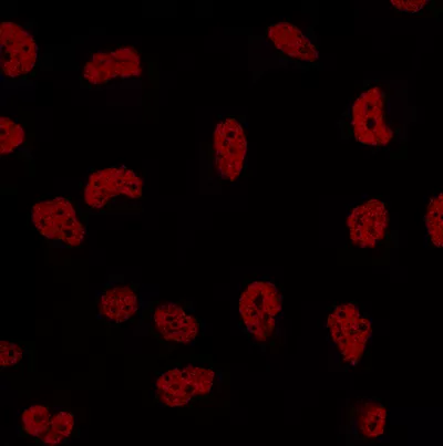 Células neoplásicas de mama triple negativo (Foto. CRG VHIO)