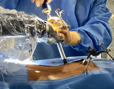 Imagen de cirugía robótica de columna en Clinico San Carlos (Fuente: Clinico San Carlos)