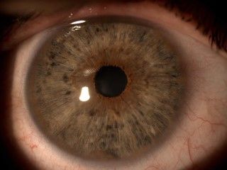Despigmentación del iris (Foto cedida a ConSalud por el Dr. Javier Hurtado)