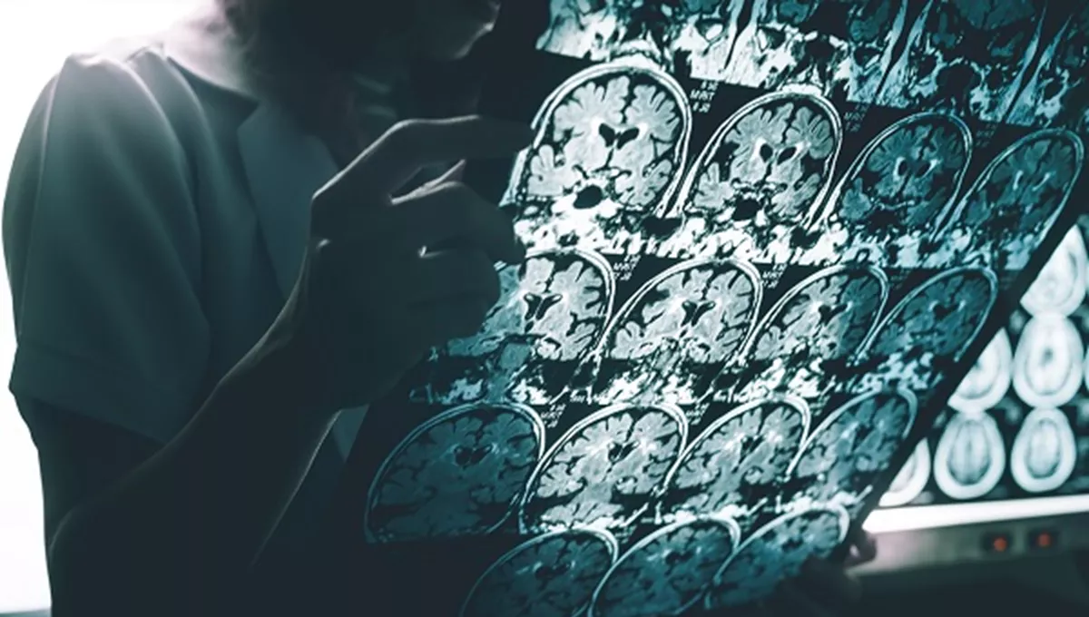 Conocer la evolución del alzhéimer desde sus etapas más tempranas es uno de los retos de la ciencia (Foto. Shutterstock)