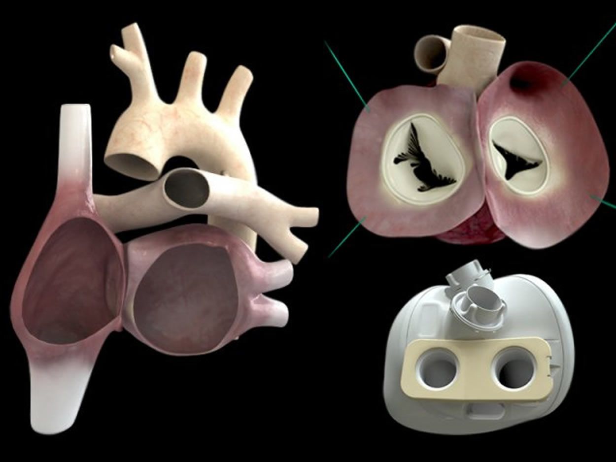 Corazón artificial desarrollado por Carmat