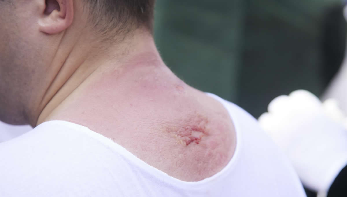 Detalle de lesión en el cuello de un costalero (Joaquin Corchero/Europa Press)
