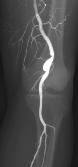Aneurisma de la arteria poplítea (Foto. Hospital Ruber Internacional)