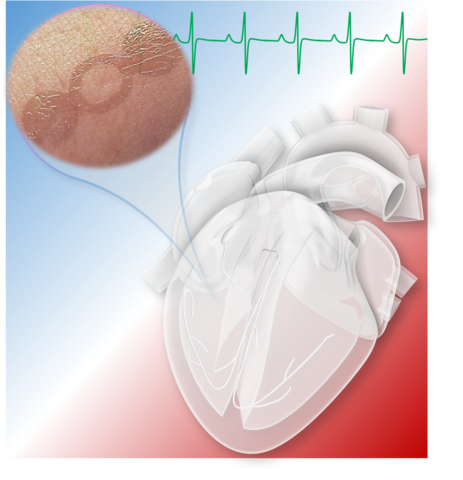 Una ilustración de cómo se aplicaría al corazón el marcapasos de grafeno desarrollado por Dmitry Kireev.