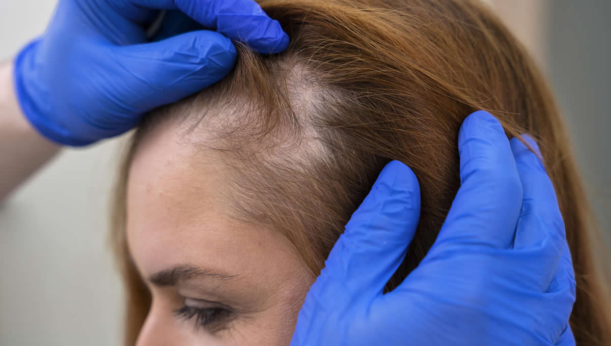Nuevo tratamiento sin dolor para la alopecia areata (Foto. Freepik)