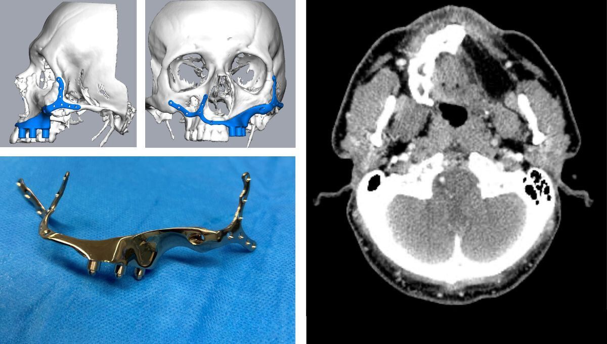 Imágenes de la reconstrucción maxilar (Fuente: Hospital Rey Juan Carlos)