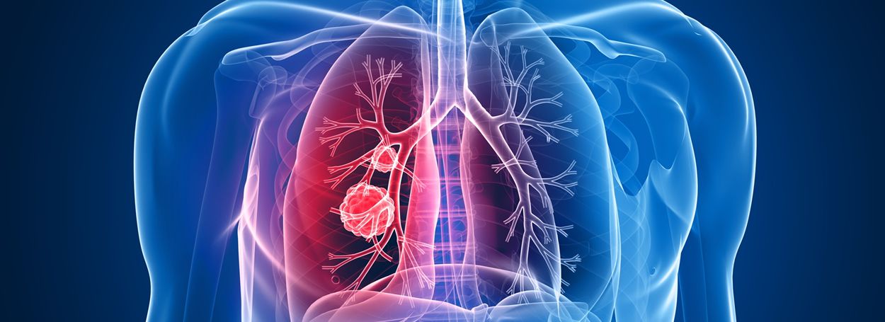 Cada año se diagnostican entre 25.000 y 27.000 nuevos casos de cáncer de pulmón.