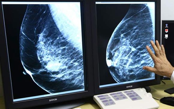La posibilidad de salvar una vida con el uso de la mamografía es 100 veces mayor que la de morir por su radiación 

