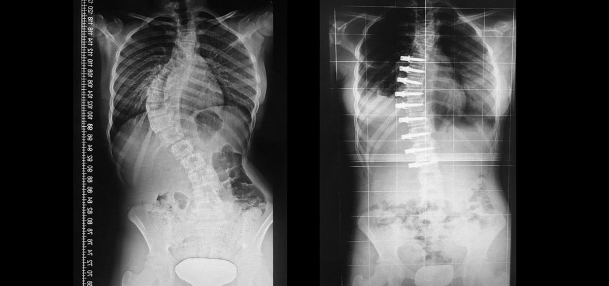 La paciente presentaba una escoliosis idiopática de 65 grados (izquierda) que se ha disminuido a 12  tras la intervención (derecha)