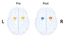 Cambios en la activación funcional de la amígdala cerebral en un paciente con esquizofrenia antes de realizar la terapia cognitivo conductual (izquierda) y después (derecha)