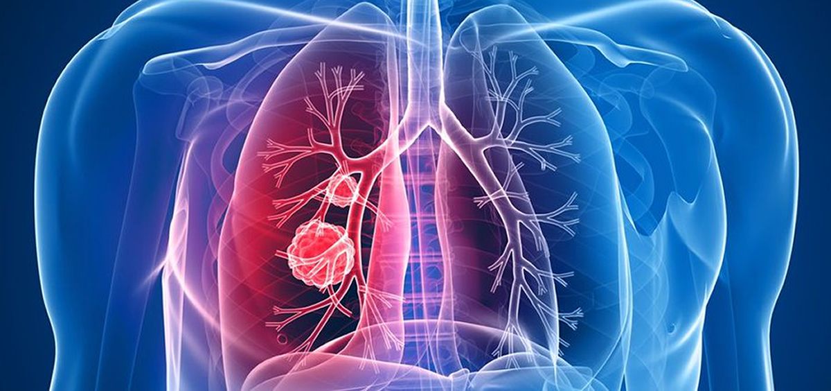 El quirófano híbrido agiliza el diagnóstico y tratamiento del cáncer de pulmón