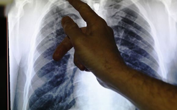 El gasto sanitario de la tuberculosis supera los 51 millones de euros en España