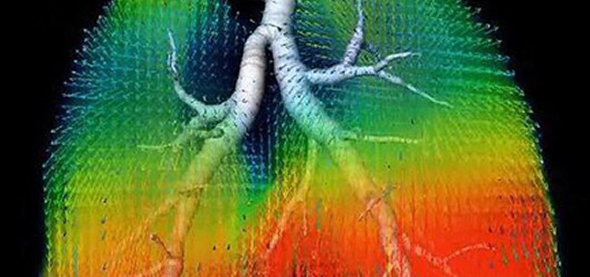 Los algoritmos calculan la cantidad de aire que recibe cada área del pulmón generando una imagen codificada por colores