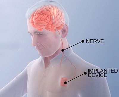 the implant for stroke2
