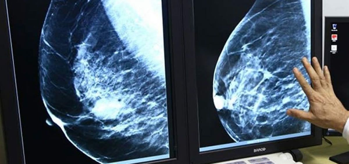 Se consigue erradicar por primera vez un cáncer de mama metastásico con inmunoterapia