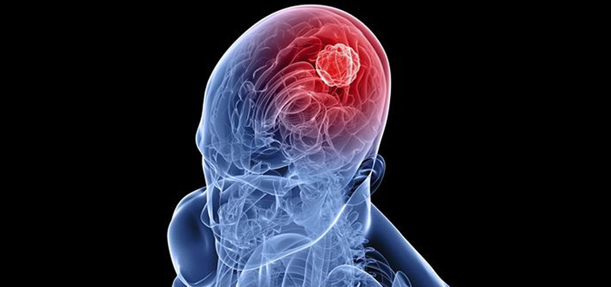 Los avances en los tumores del Sistema Nervioso Central
