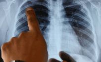 Un nuevo sistema diagnostica con más precisión las enfermedades respiratorias crónicas