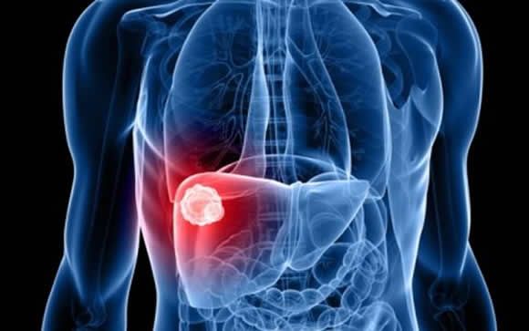 Asocian niveles bajos de selenio con más riesgo de desarrollo de cáncer de hígado