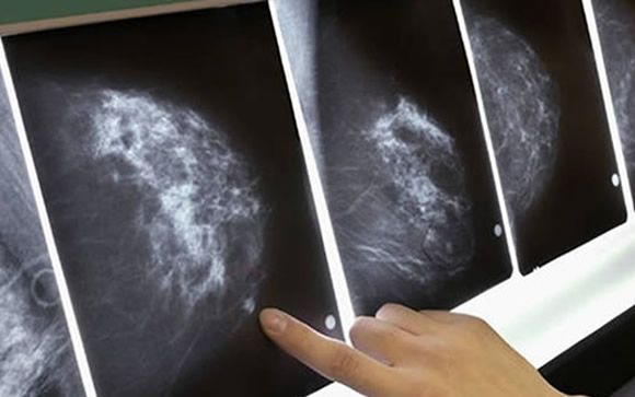 Investigadores españoles lideran un nuevo estudio para tratar el cáncer de mama más frecuente
