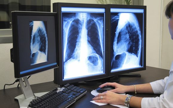 La biopsia líquida y la secuenciación masiva ponen apellido al cáncer de pulmón