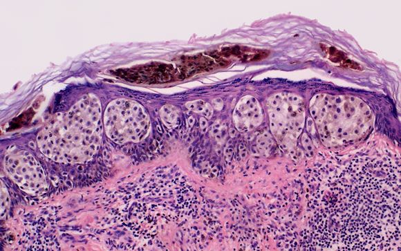   Células escondidas en melanomas que resisten a los tratamientos