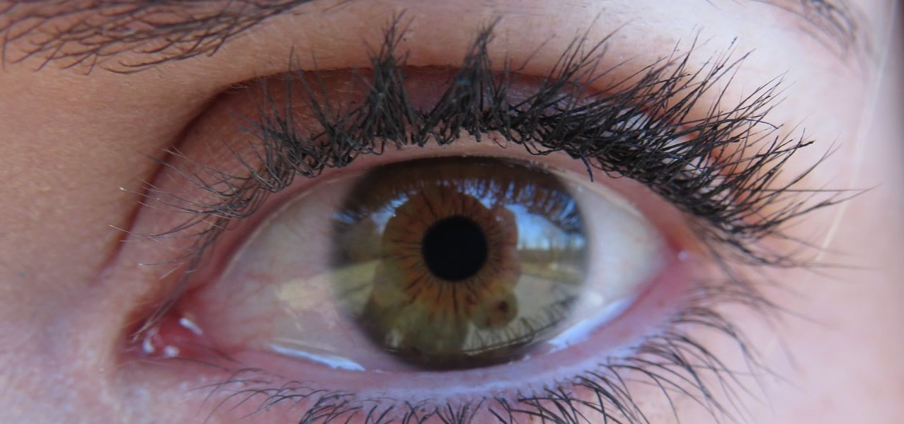 La uveítis es la inflamación de la úvea o capa media del ojo, formada por el iris, el cuerpo ciliar y las coroides.