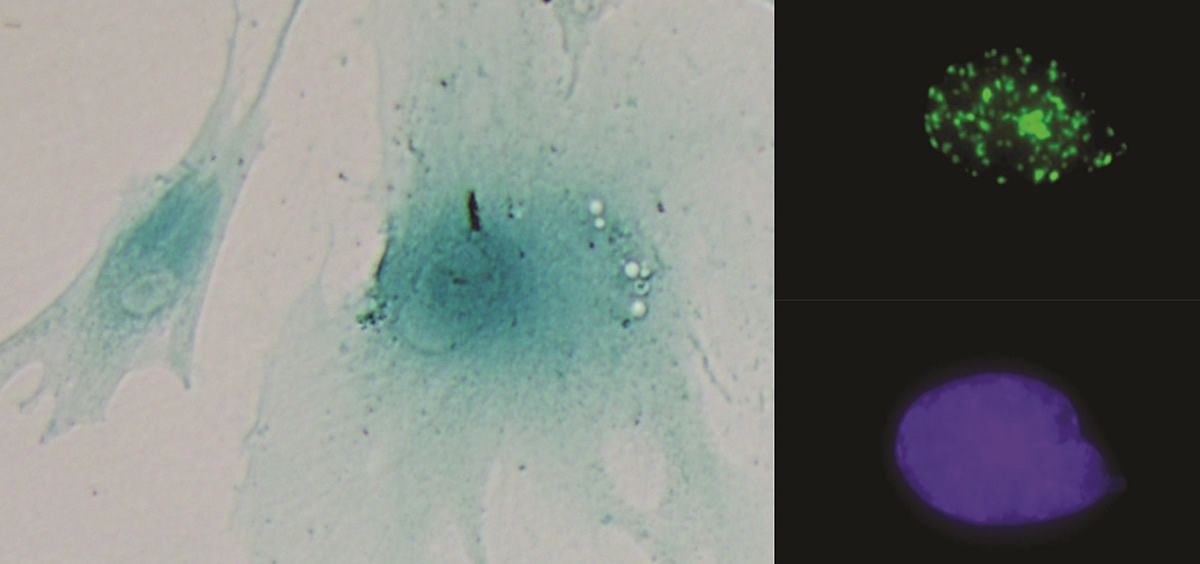 Imágenes de dos células senescentes (izquierda). A la derecha un núcleo celular mostrando foco de daño al ADN (arriba) y su control (abajo)