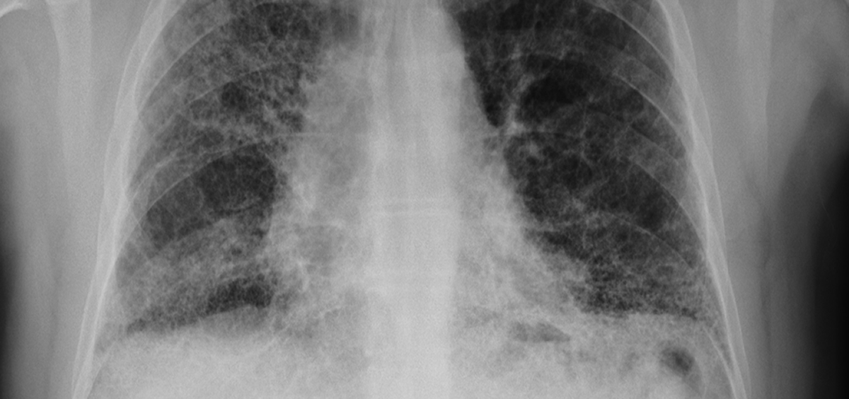 Radiografía de tórax que hace sospechar un posible diagnóstico de enfermedad pulmonar intersticial
